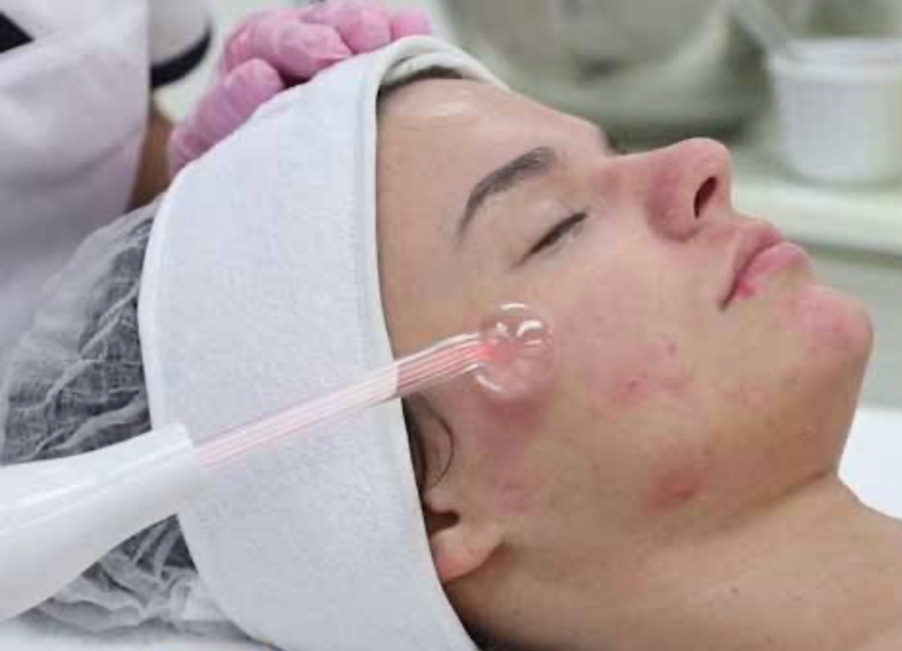 Acne Facial