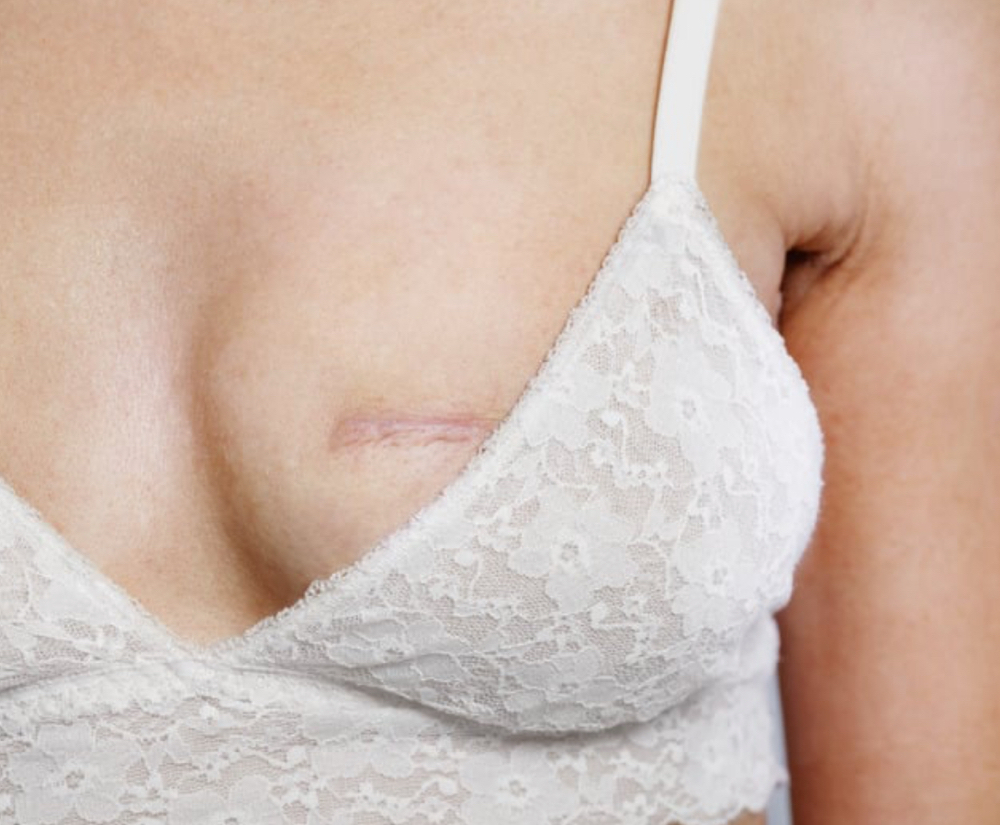 Areola Scar Camouflage