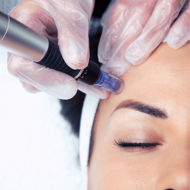 Microneedling