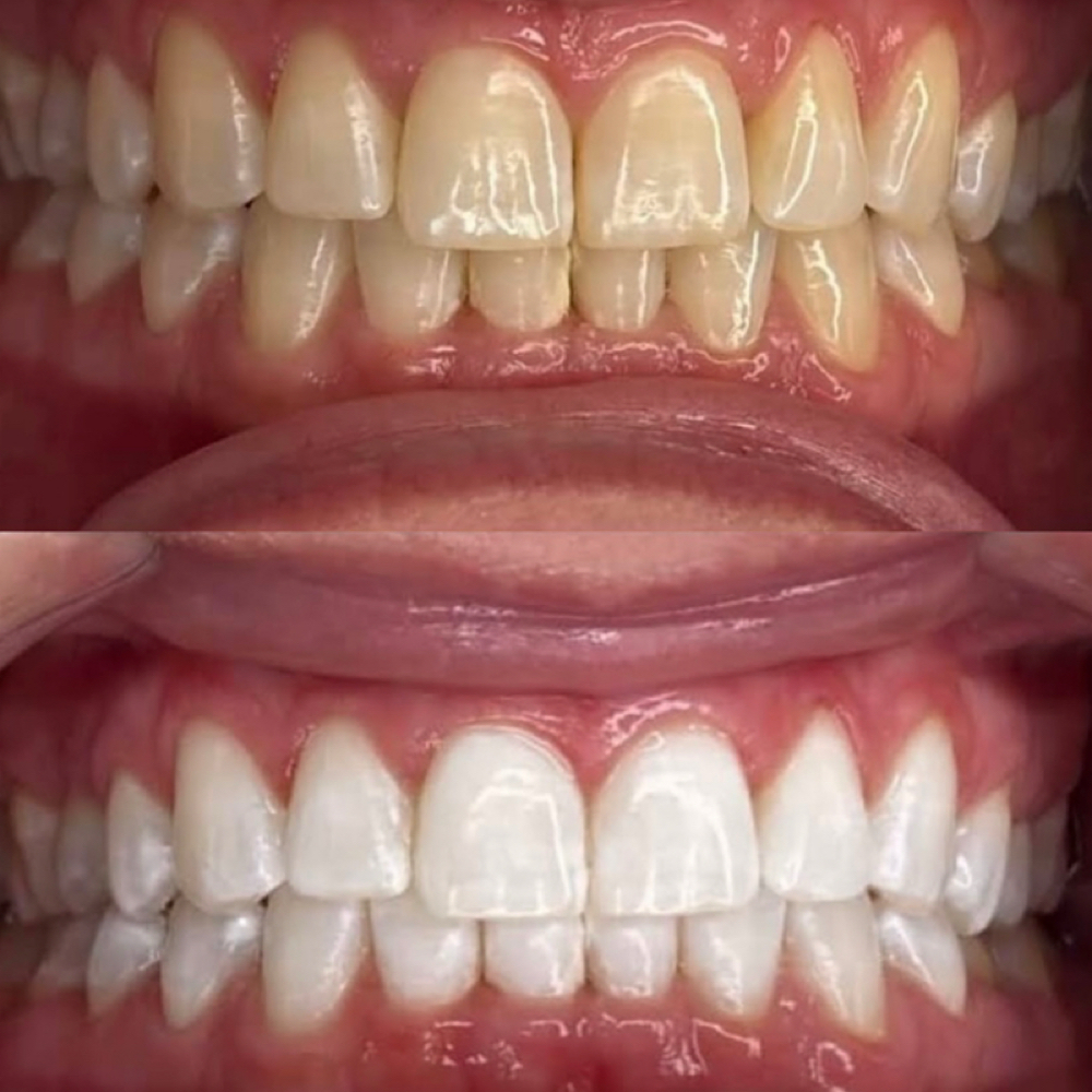 Deluxe - Daily Glow (Most popular) at Luna Smiles in Lexington, SC