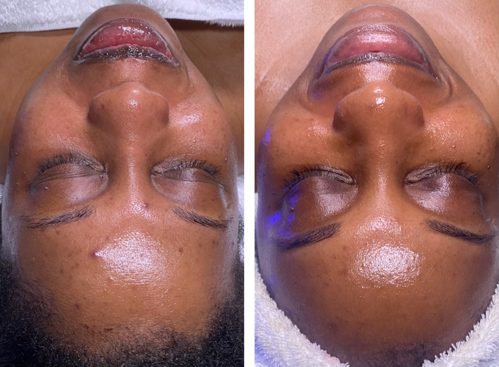 Acne HydraFacial at Beauty Therapy by Chanel in Tucker, GA