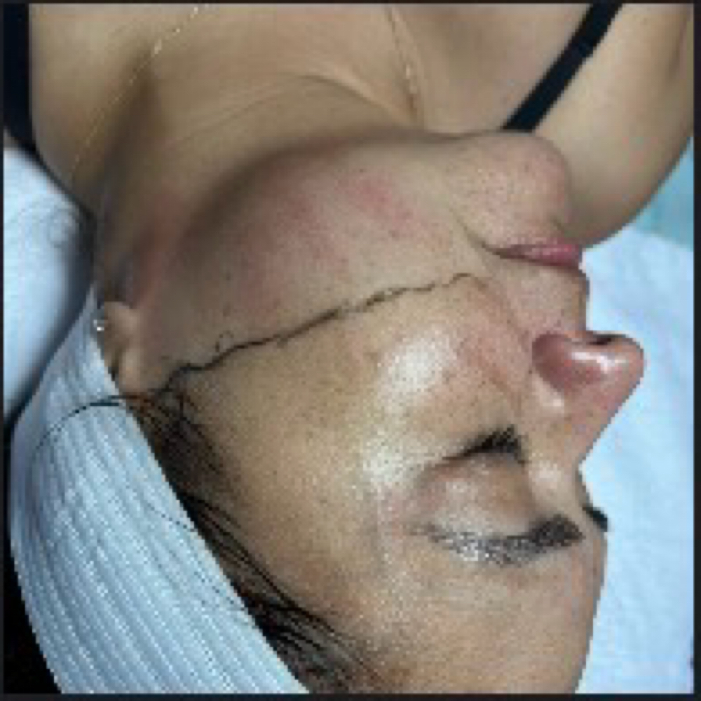 Dermaplane at Beauty And Body in San Dimas, CA