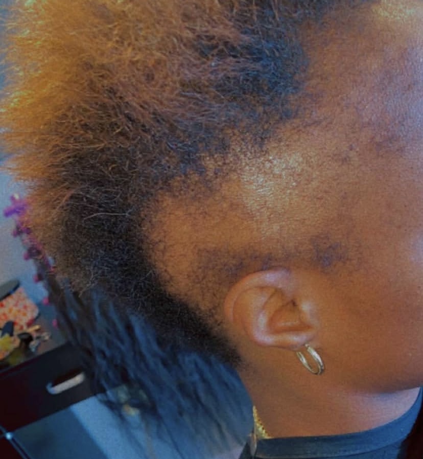 BRAIDED STYLES FOR ALOPECIA