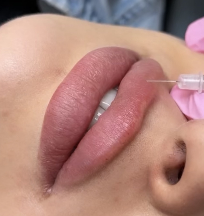 Lip Filler Full Syringe **sale**