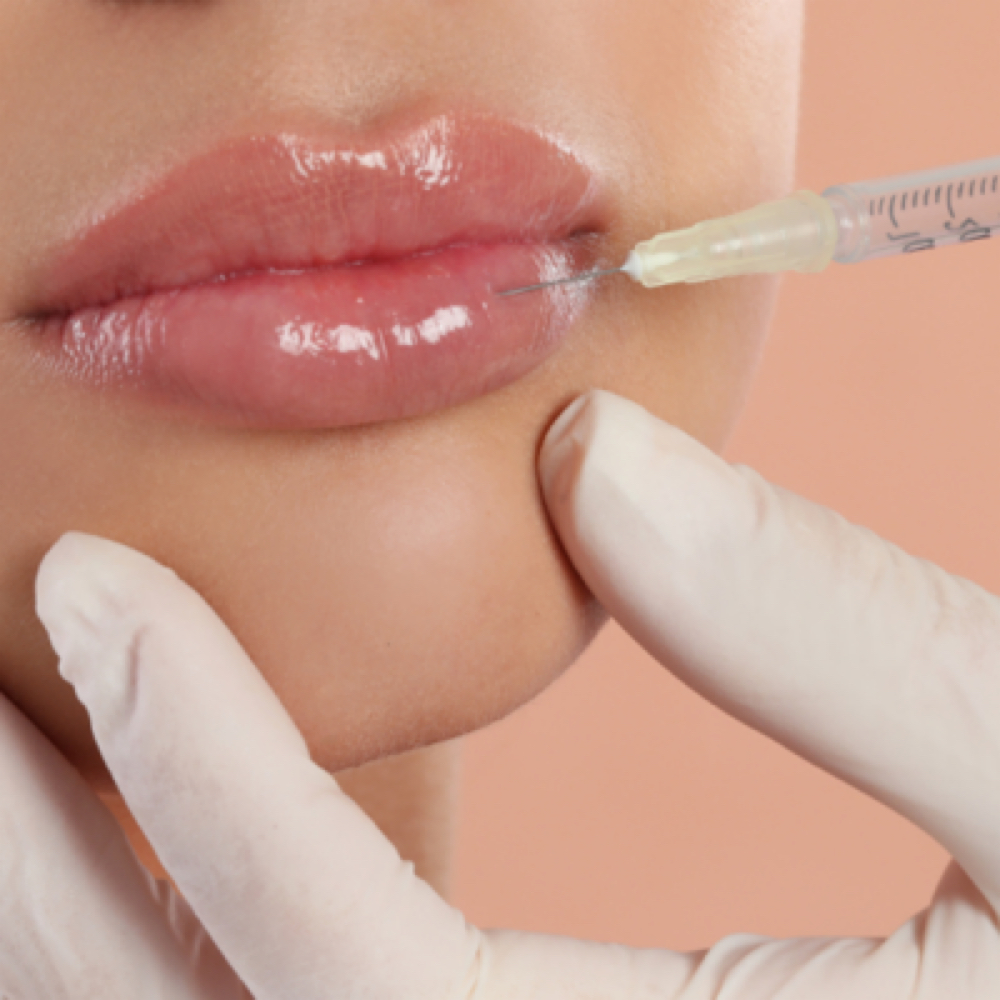 Lip Filler (Half Syringe) at Injections Aesthetics By Lisa in San Antonio, TX