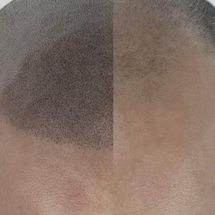 Scalp Micropigmentation at Embrace Beauty Ink in Libertyville, IL