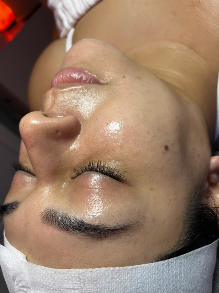 DERMAPLANE FACIAL