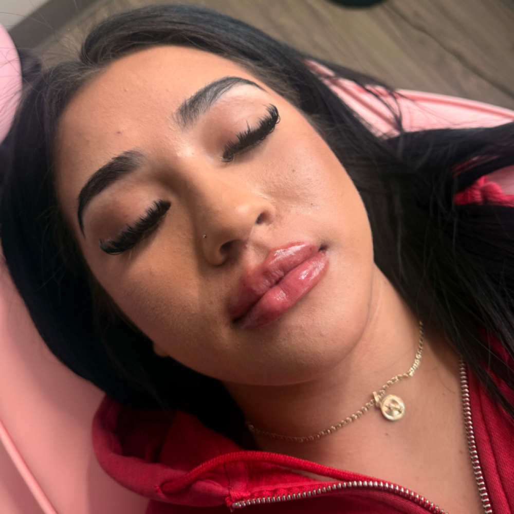 Nano Needle 1.5ml💉👄 at Dolls.luxury.lips in Chicago, IL