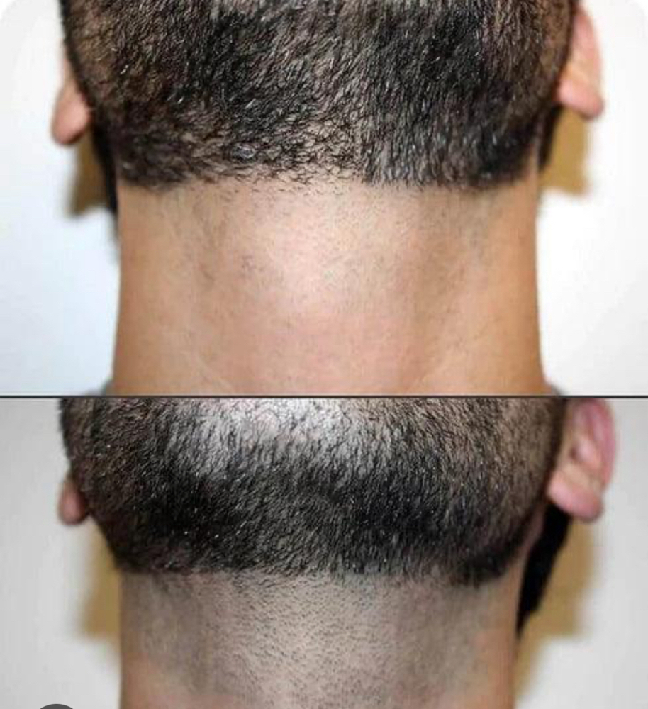 Beard Line -laser Hair Removal