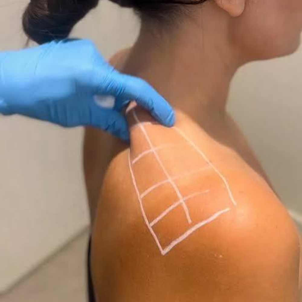 Established Pt-Trap Tox at Golden Glow Aesthetics in Patterson, MO