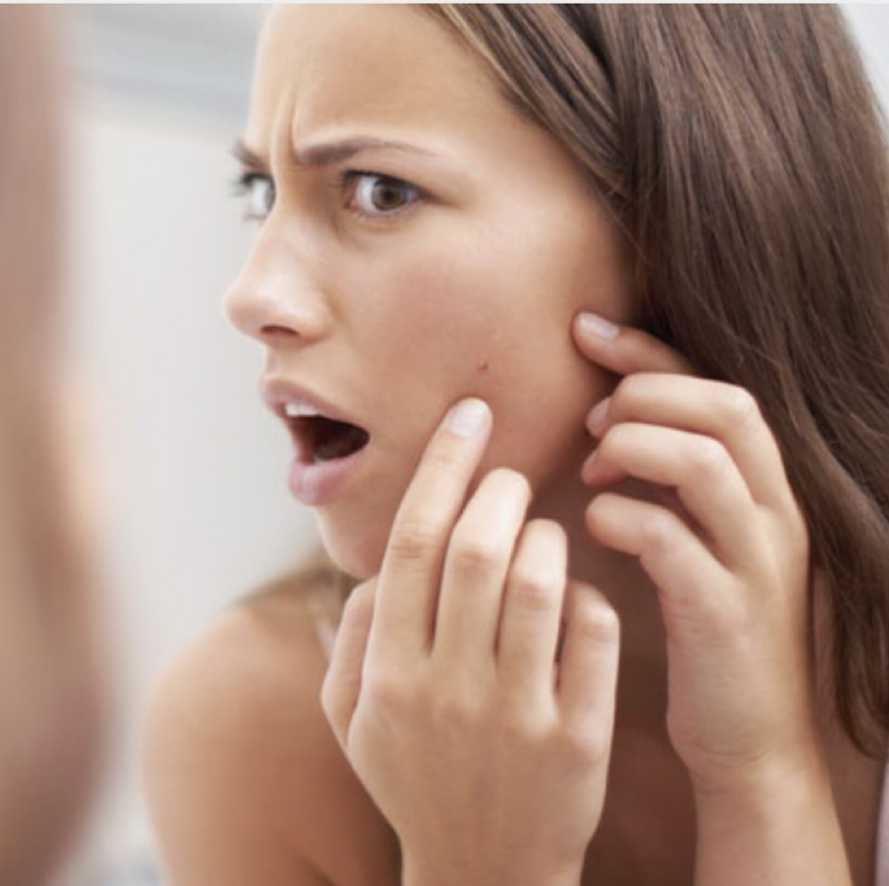 Acne Remedies (Teen/Adult) (80min) at Wellness Body to Soul in Jenison, MI