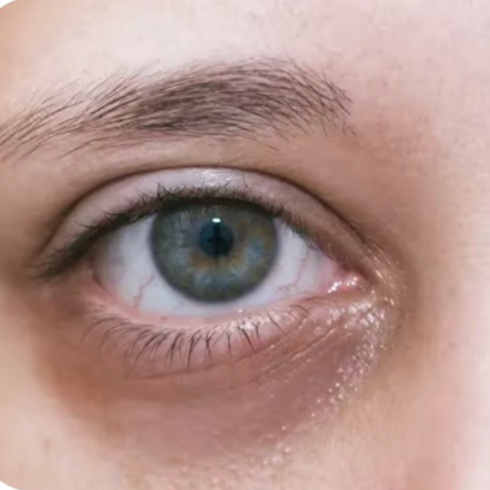 Dark Circle Under Eye Treatment at Revive Wellness in El Paso, TX