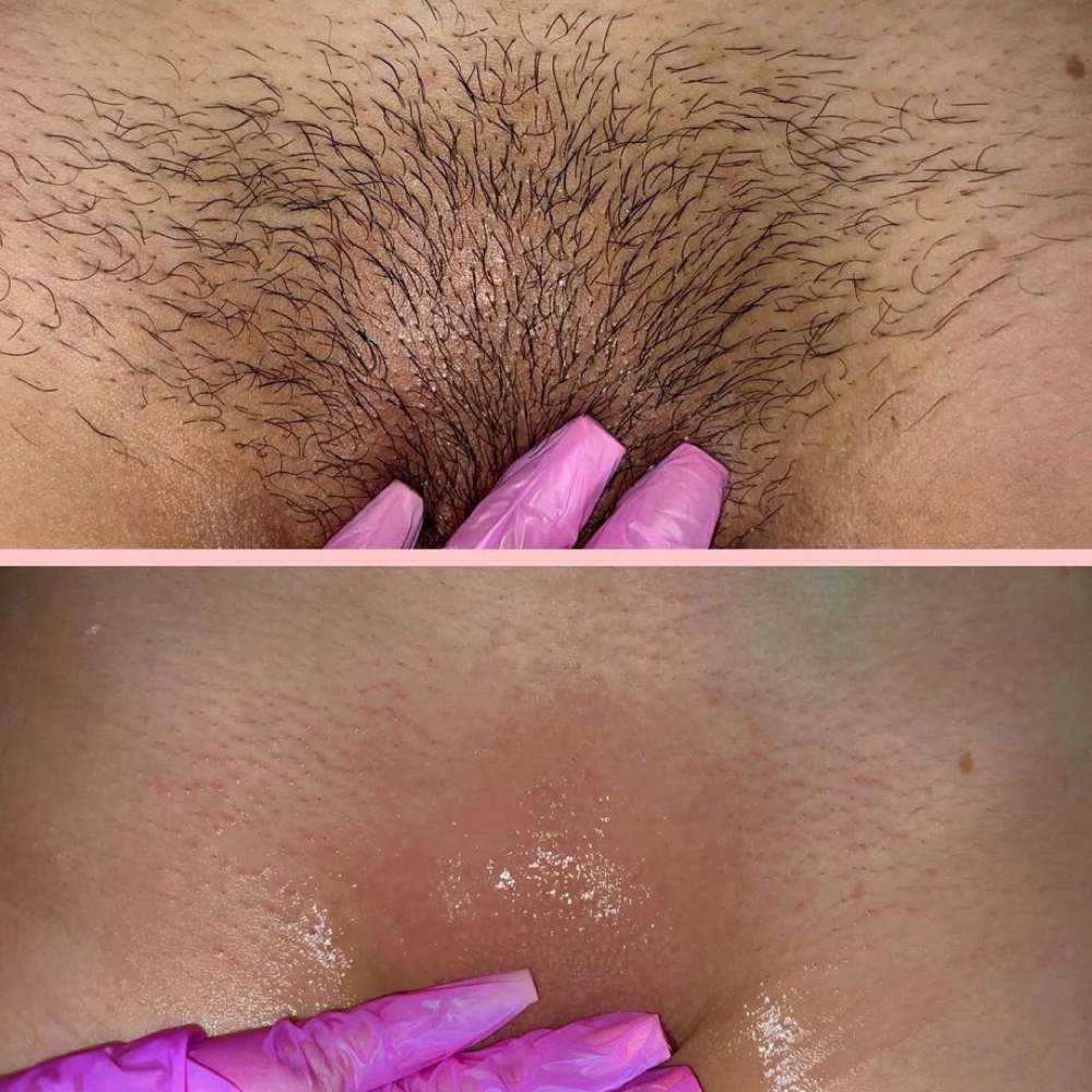 Brazilian Wax at So Esthetics in Tucson, AZ