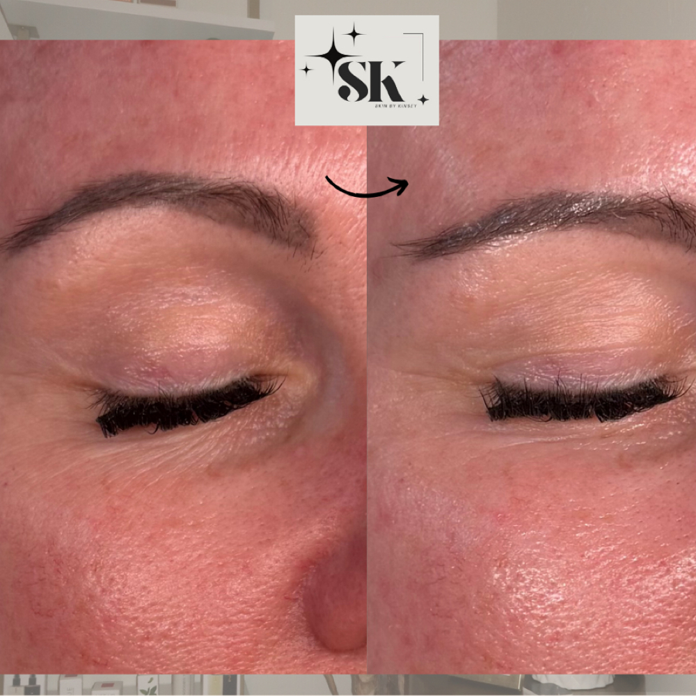 Level 2+ Peel at SKINSEY in Oklahoma City, OK