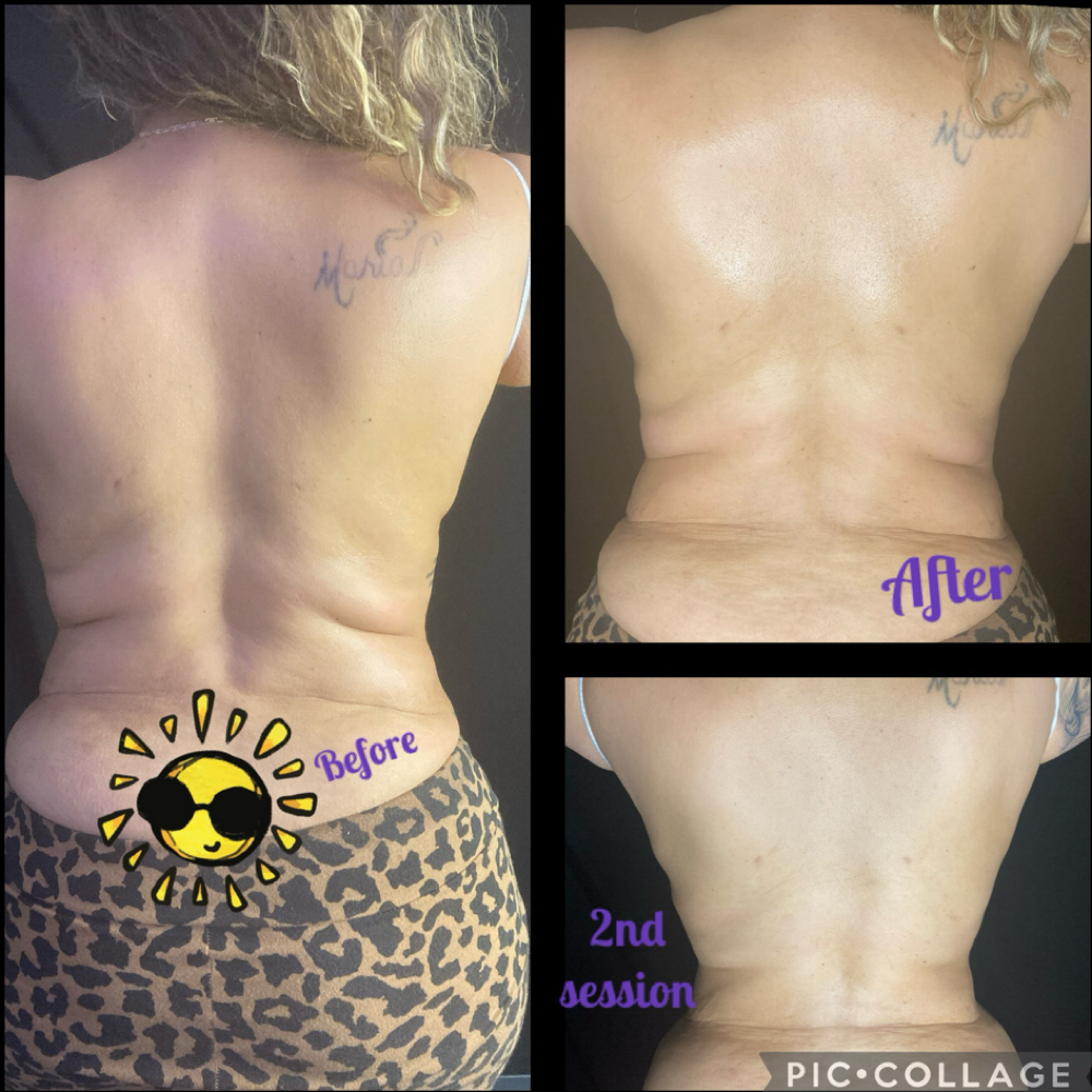 Lemon Fat Dissolver Treatment at Glo’s Beauty Creations