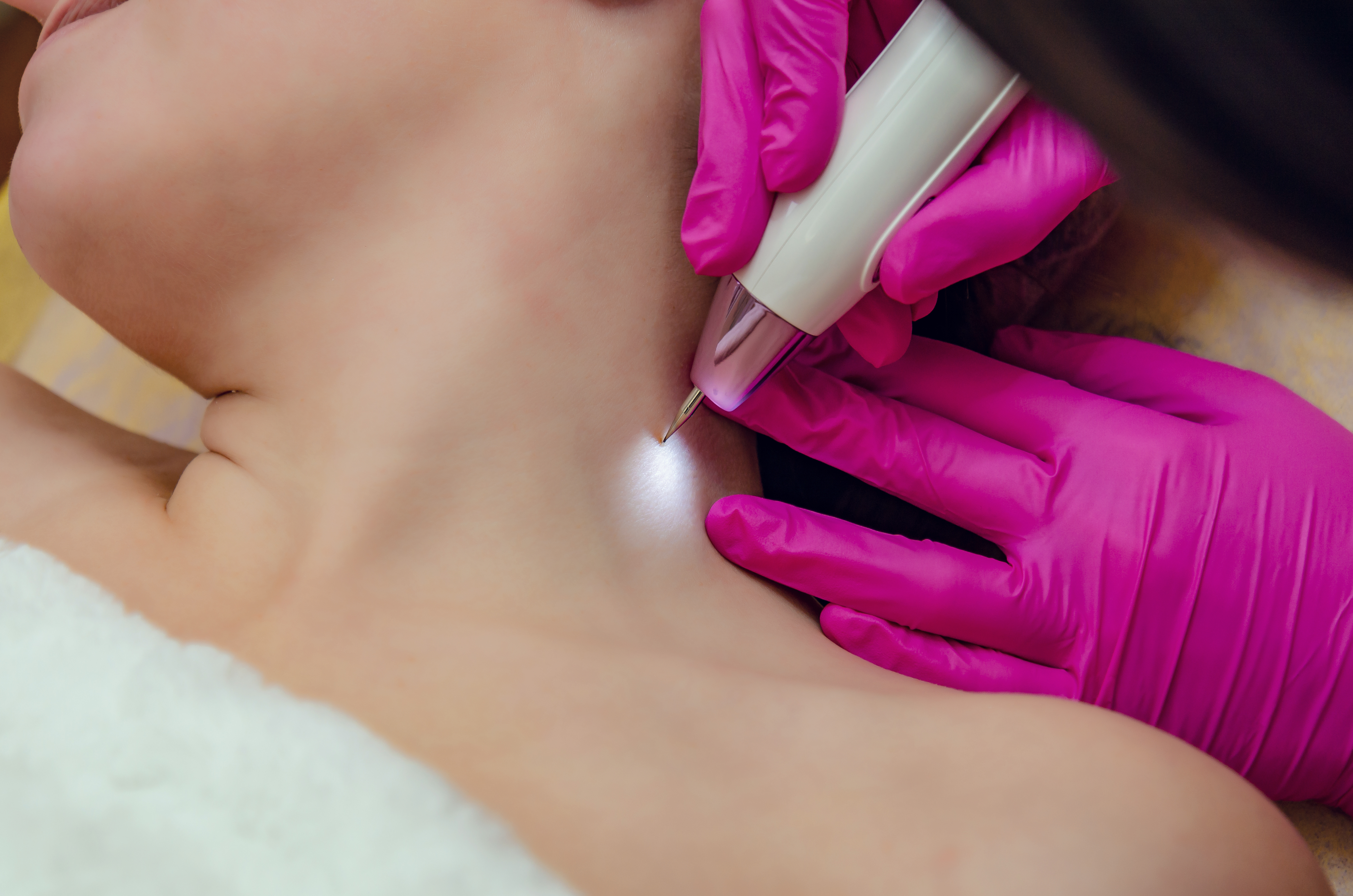 Skin Tag Removal or Cherry Angioma