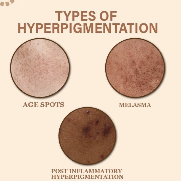 Hyperpigmentation Facial