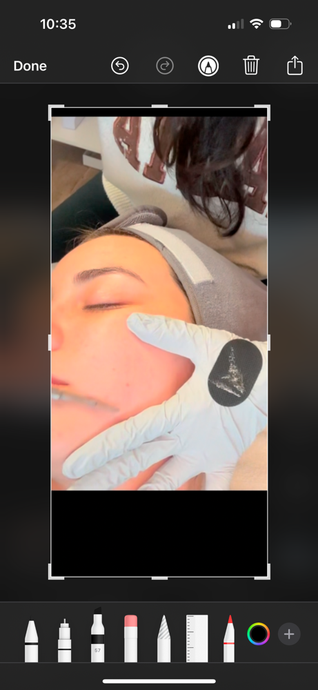 Dermaplaning