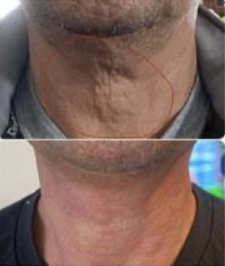 Neck~ Procell Micro-Channeling