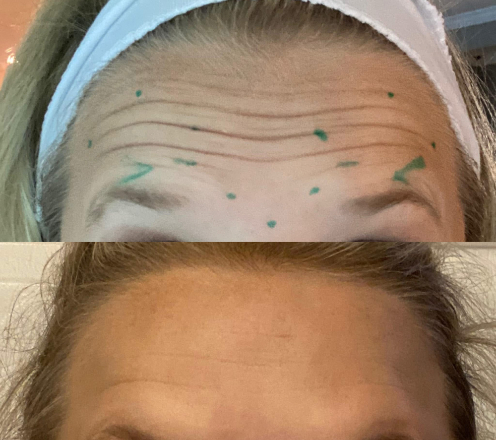 XEOMIN (botulinium toxin) at Candice Stacy in Gilbert, WV
