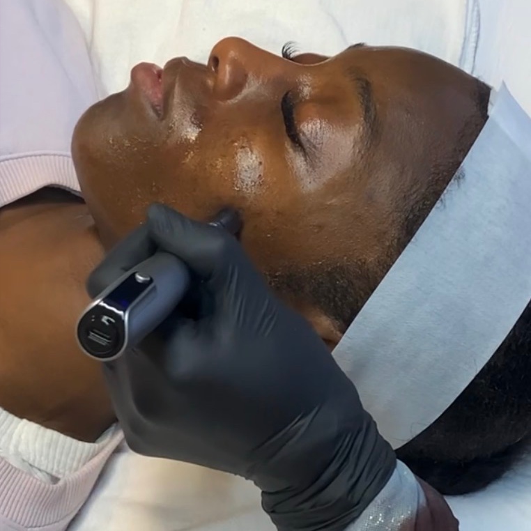Acne Dark Spot Microneedling at Glow Aesthetics Studio in Atlanta, GA