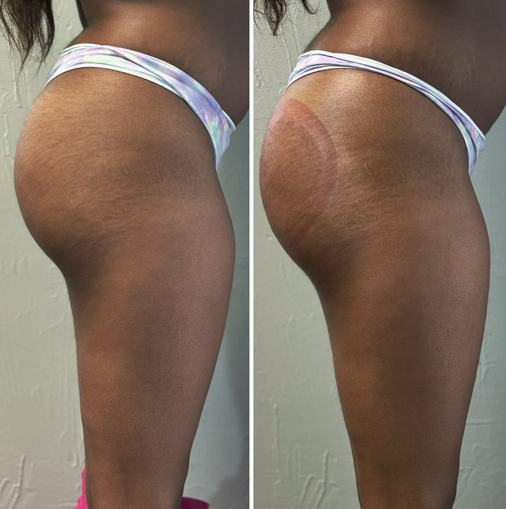Non-Invasive BBL