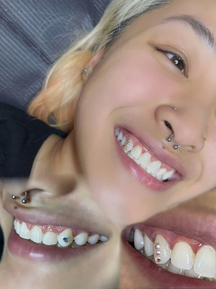 Custom Tooth Gems