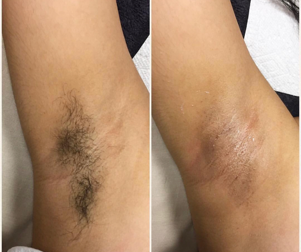 Underarm Wax