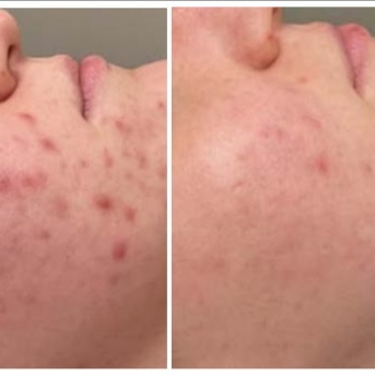 Clear Skin Bundle at Premier Clinical Aesthetics in Ocala, FL