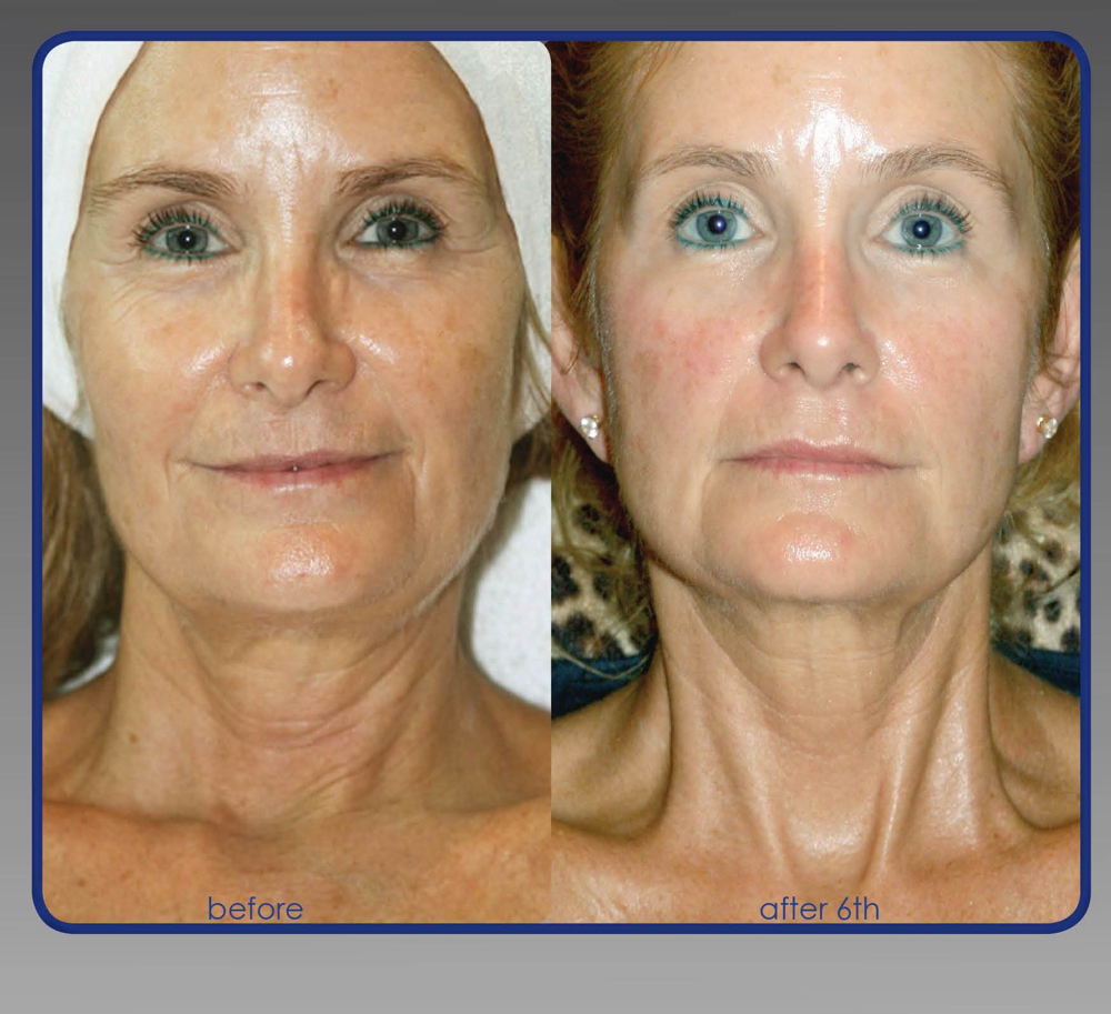 SWiCH Dermal Rejuvenation System