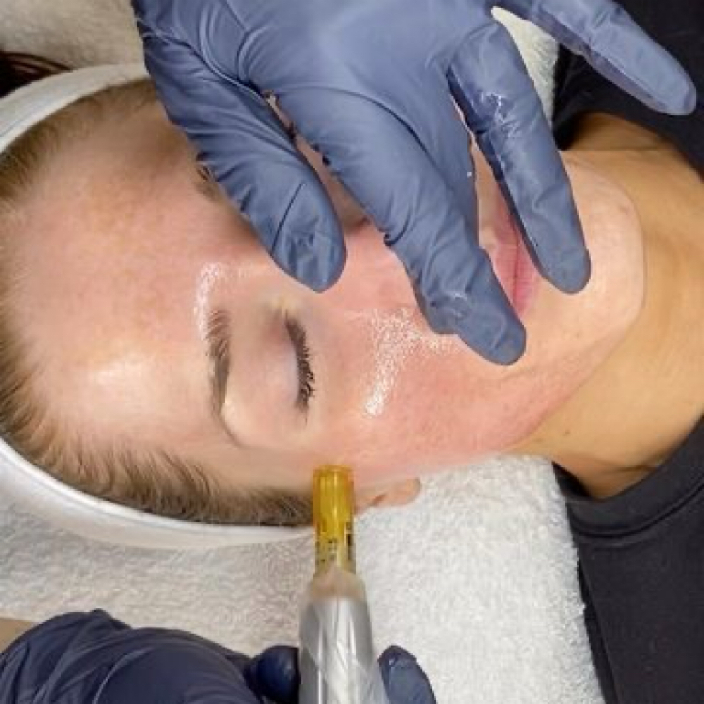 Microneedle Facial at PR Beauty Bar in Conway, AR