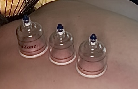 Cupping Massage