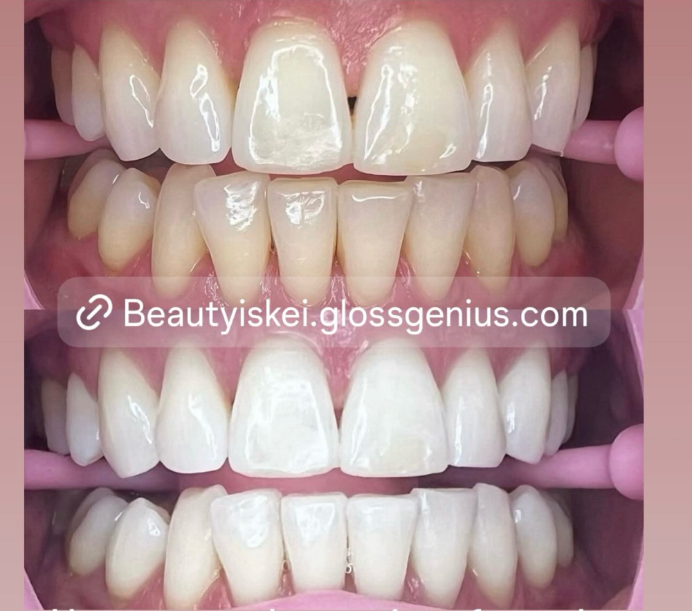 Basic Teeth Whitening