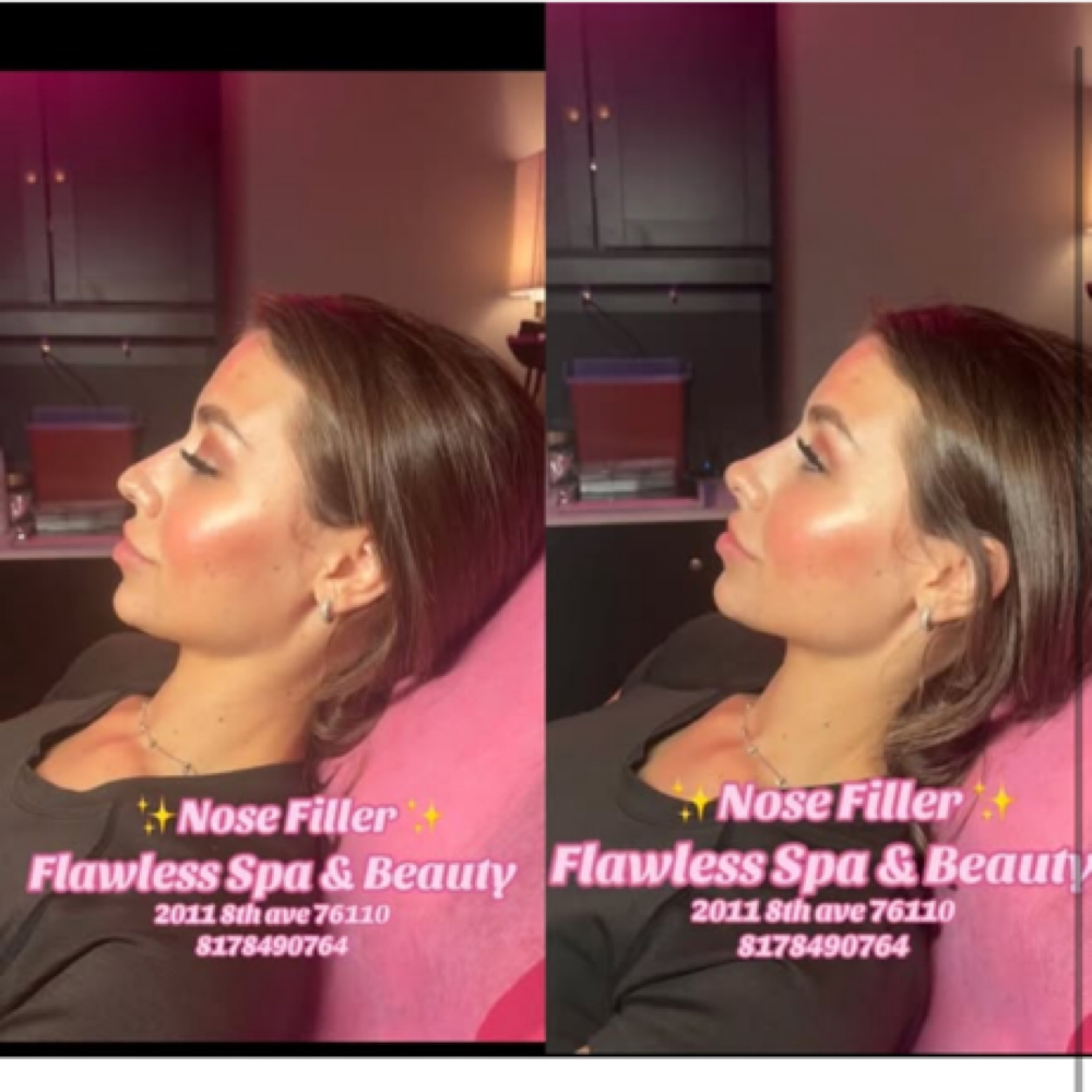 Non Surgical Nose Filler at Flawless Spa & Beauty in Fort Worth, TX