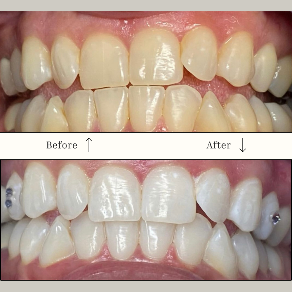 60 Minute Whitening Session