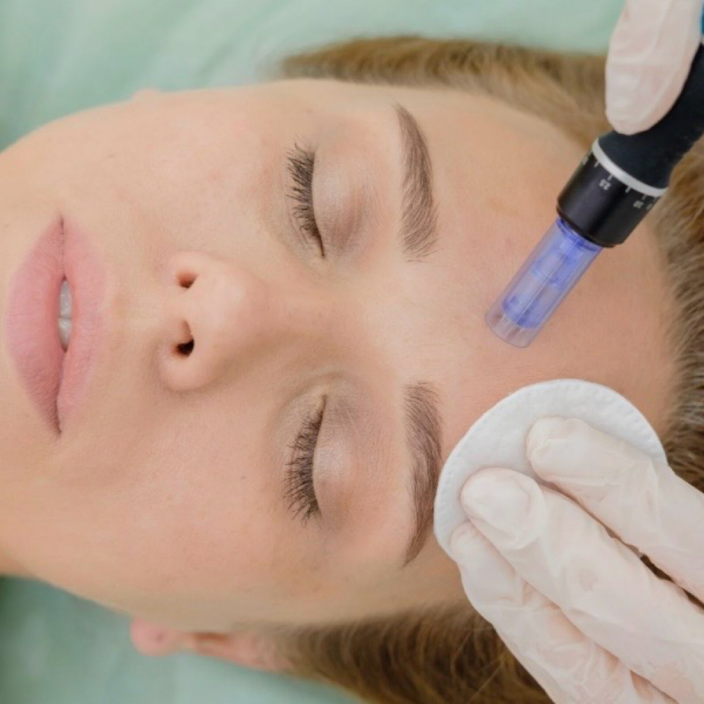 Collagen Induction Needling at COMPLEXION CORNER in West Long Branch, NJ