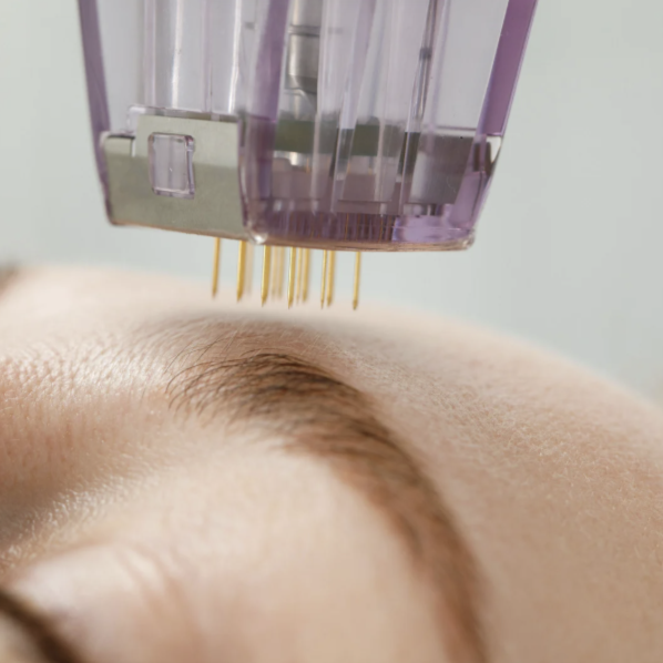 Microchanneling (Microneedling) at Unblemished Esthetics by Cam in West Columbia, SC
