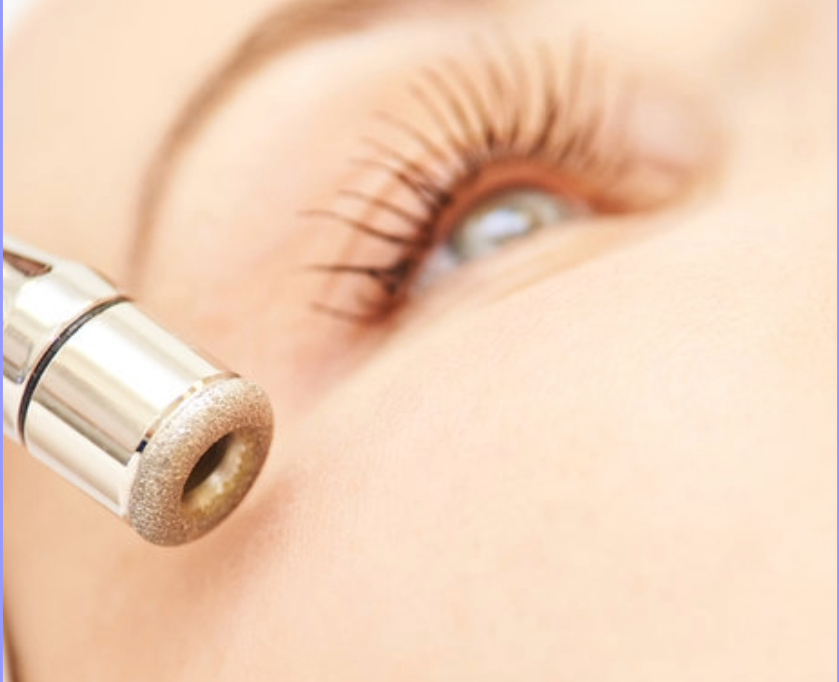 Microdermabrasion Treatment