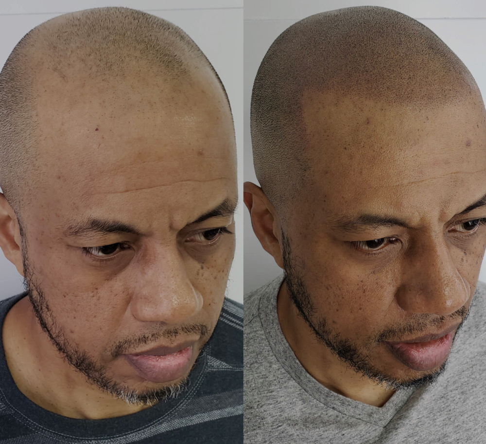 Hairline/Scalp Micropigmentation