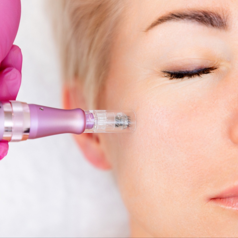 Microneedling