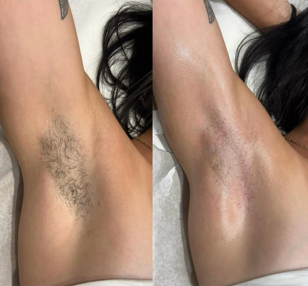 Underarms