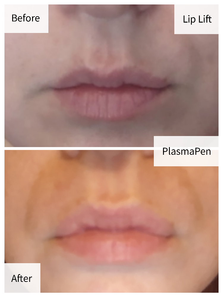 Lip Flip/ Perioral Augmentation