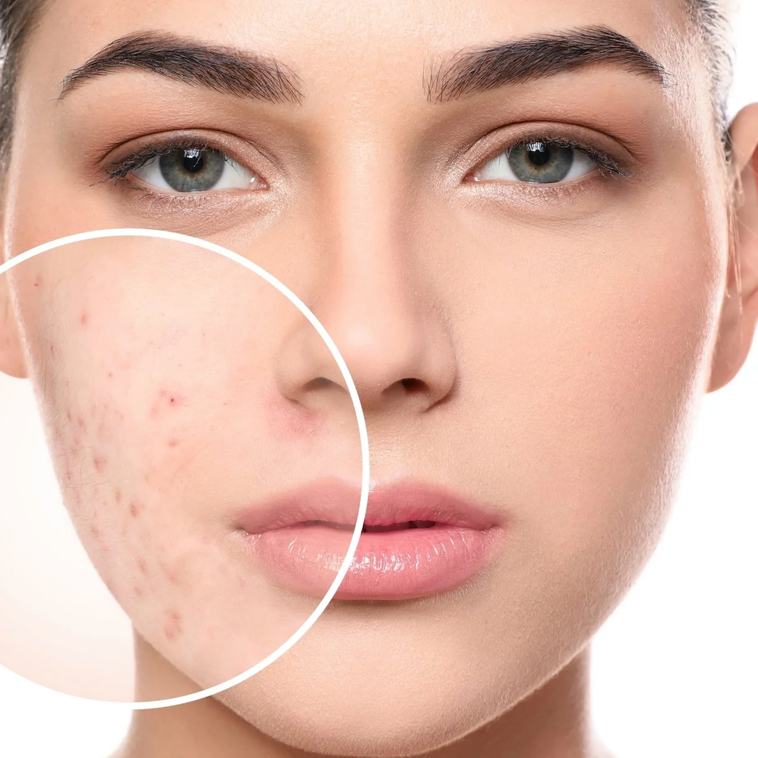 Acne Treatment | Facial at SKIN + BODY Aesthetics in Troy, MI