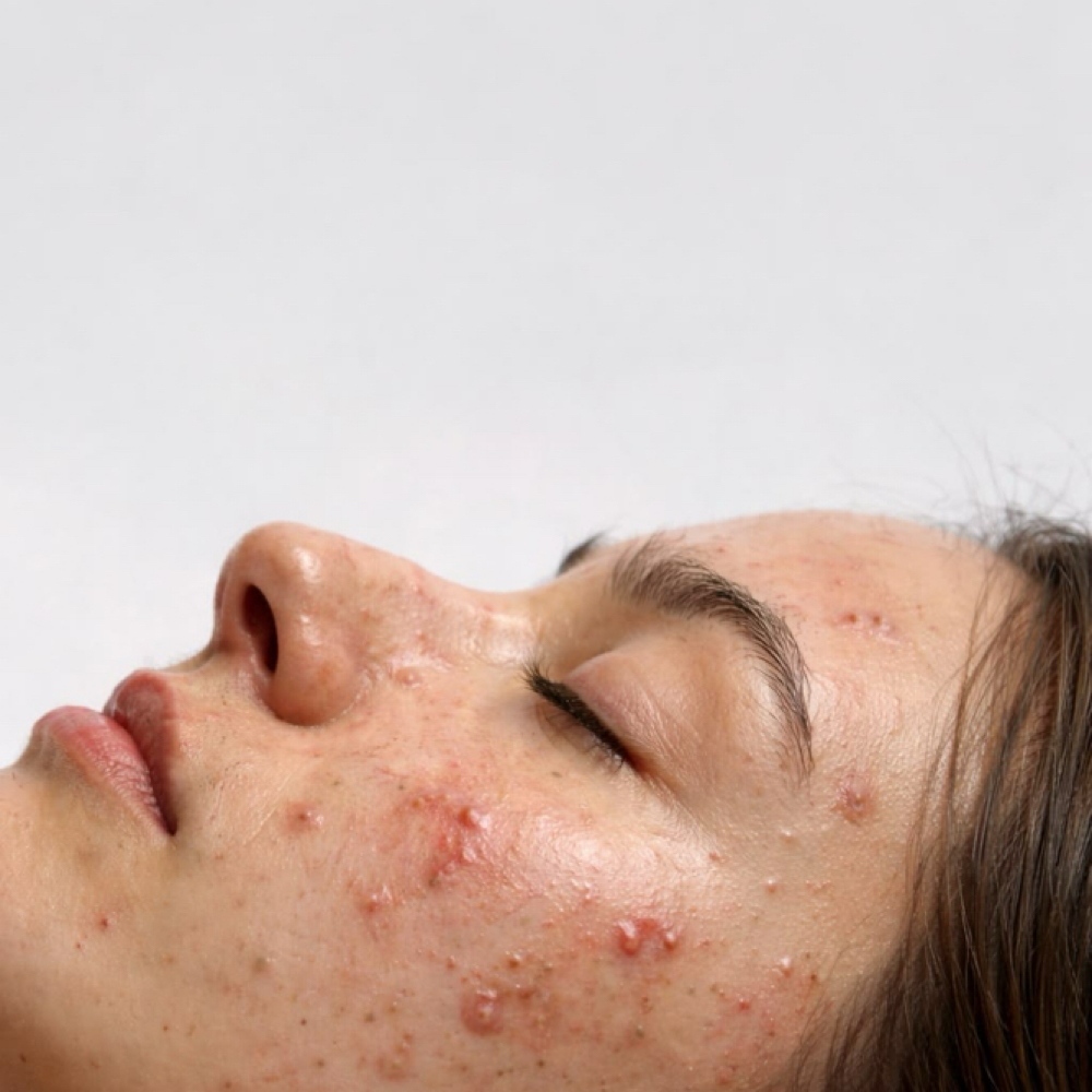 The Skin Reset Facial at Bare Skin Studio in Fishers, IN