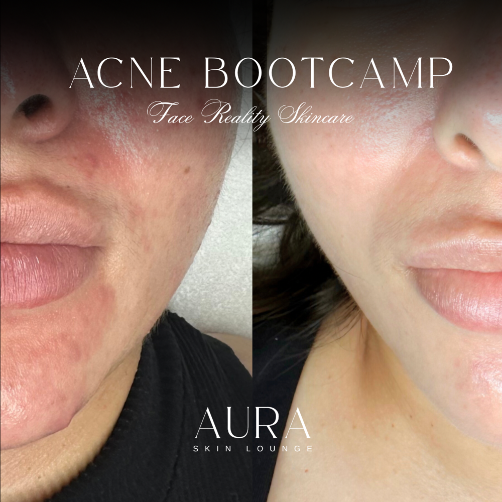 Acne Bootcamp Package