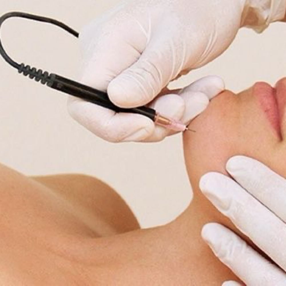 15 Minute Electrolysis at Ama Aesthetics Studio in Methuen, MA