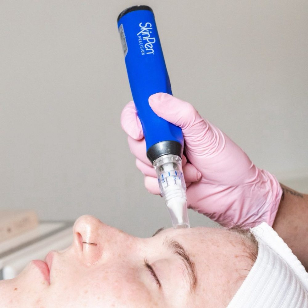 SkinPen Regenerative Treatment at Zen Beauty in McAllen, TX