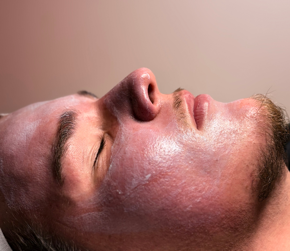 Acne Clearing Treatment at Livingood Esthetics in Richmond, KY