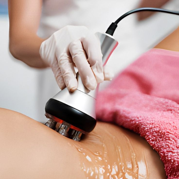 Radiofrequency at Golden Body Artistry in Oak Hill, WV