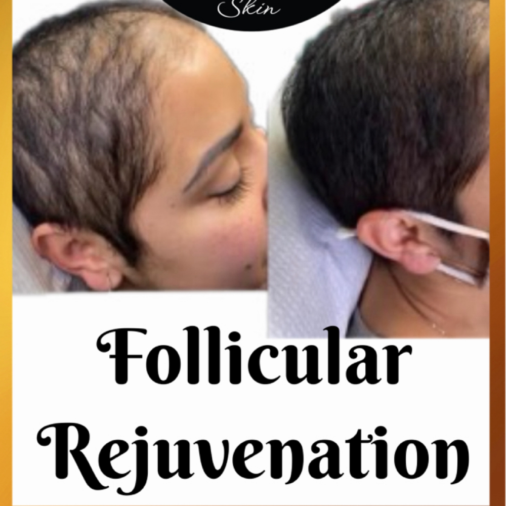 Consultation/Microscopic Scope with Advanced Hairloss Package 1 at Potent Transitions in East Orange, NJ